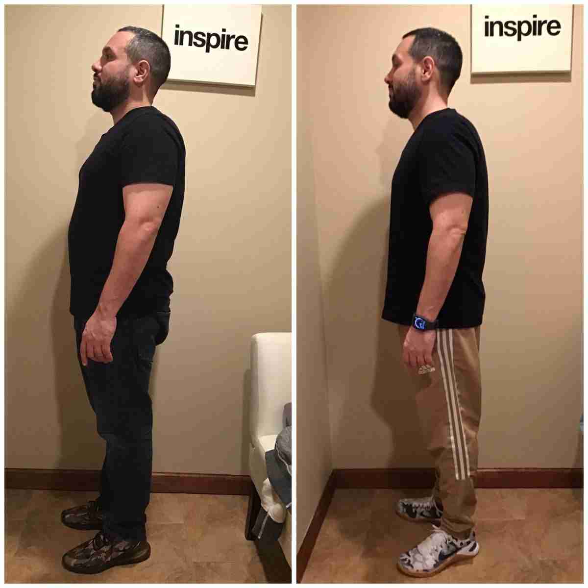 DT-Before-After-scaled-1 Essex County Weight Loss Center<br />