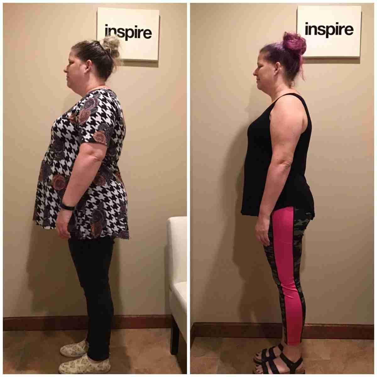 KR-Before-_-After-2nd-Round-2-Side-View-1-scaled Fairfield Weight Loss Center