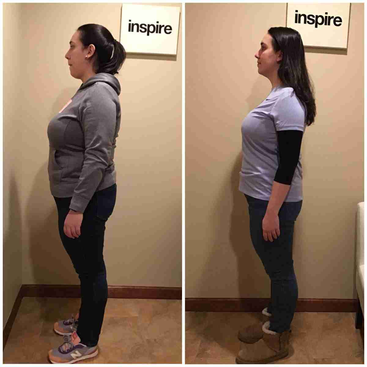 LR-Before-_-After-scaled Bloomfield Weight Loss Center