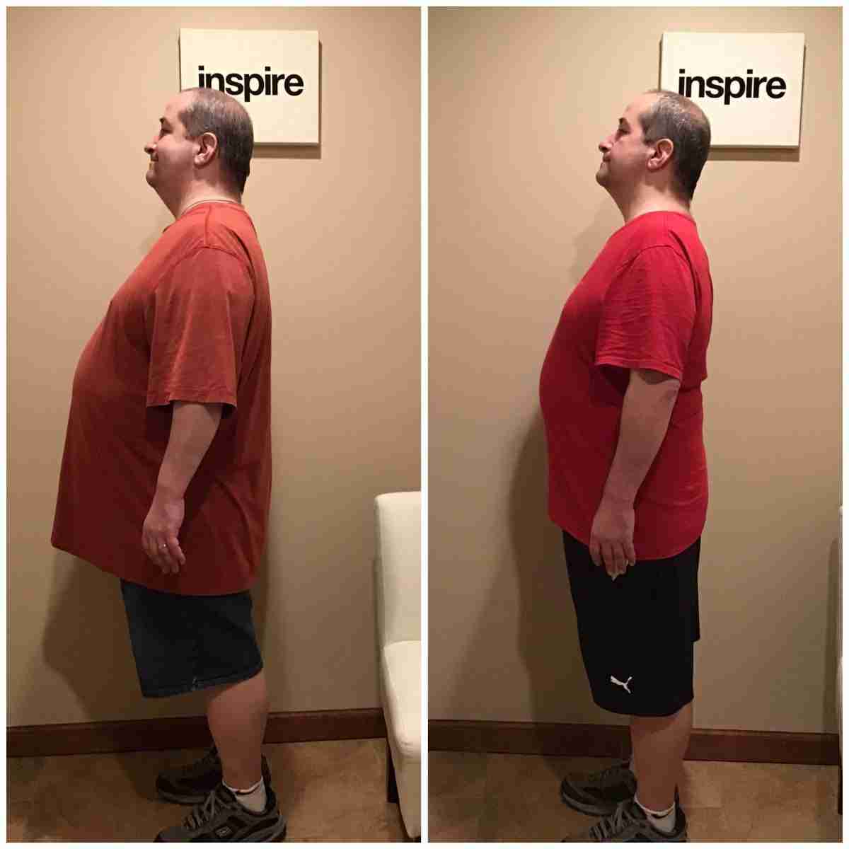 MP-Before-_-After-scaled Montclair Weight Loss Center